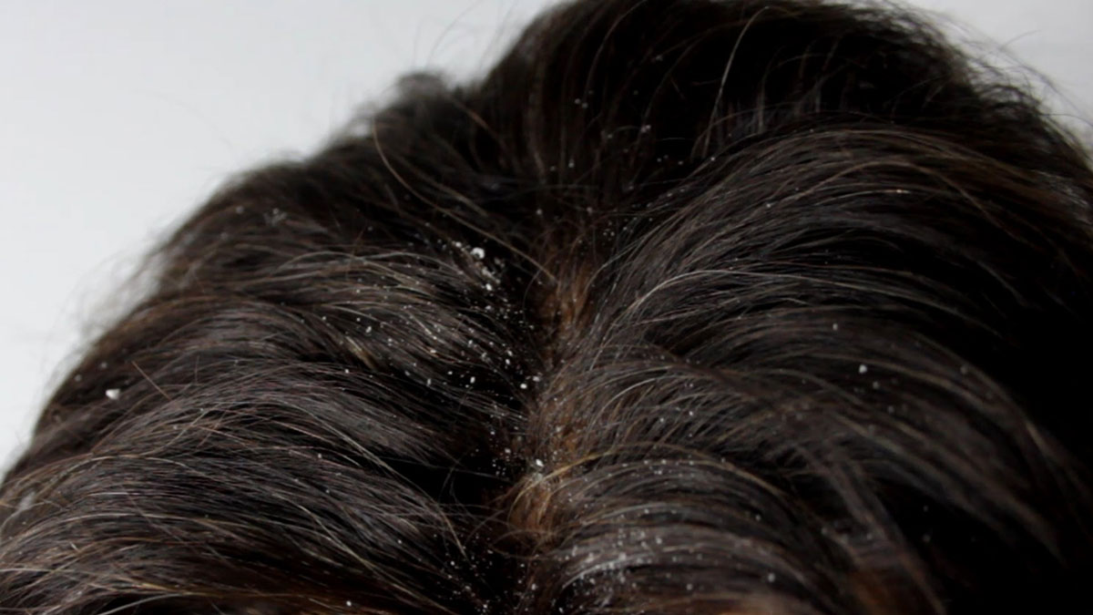 ما هو أفضل علاج لقشرة الشعر