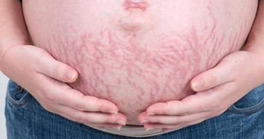 علامات تمدد الجلد للحامل